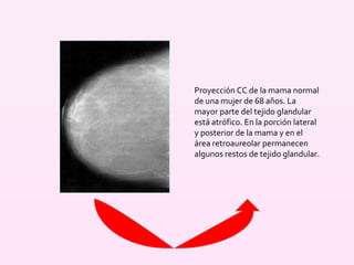 Proyección CC de la mama normal de una mujer de 68 años. La mayor parte del tejido glandular está atrófico. En la porción lateral y posterior de la mama y en el área retroaureolar permanecen algunos restos de tejido glandular. 