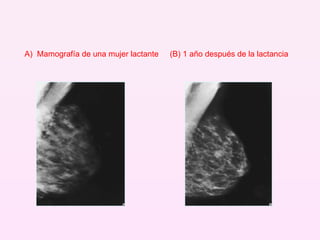 A)   Mamografía de una mujer lactante  (B) 1 año después de la lactancia 