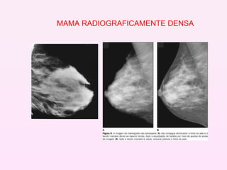 MAMA RADIOGRAFICAMENTE DENSA 