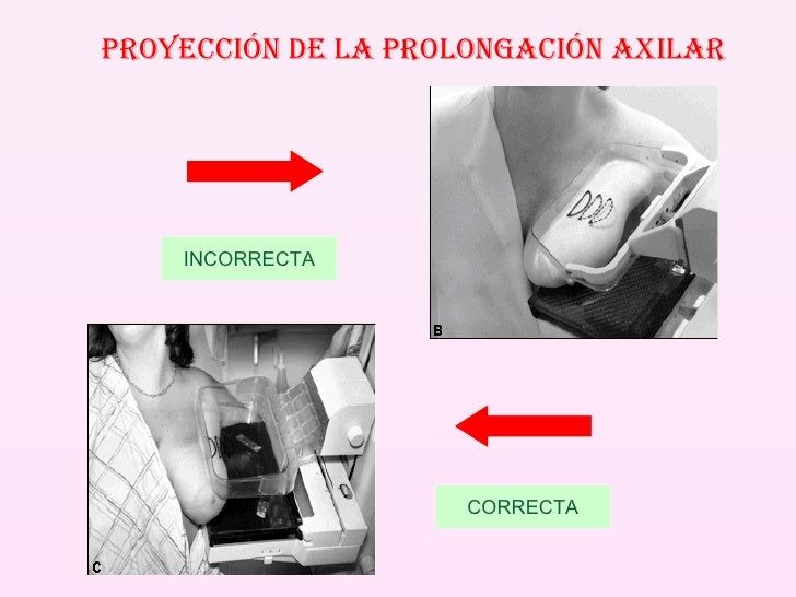 Explorando la Cola Axilar de la Mama: Todo lo que Debes Saber_2 Cola axilar de la mama_2