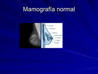 Mamografía normal 