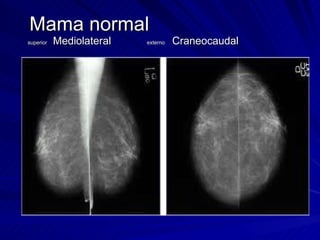 Mama normal  superior   Mediolateral  externo  Craneocaudal  