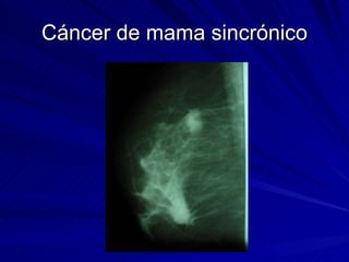 Cáncer de mama sincrónico 