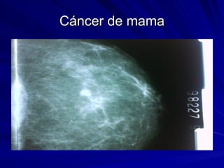 Cáncer de mama 
