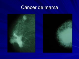 Cáncer de mama 
