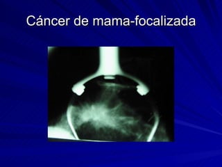 Cáncer de mama-focalizada 