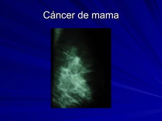 Cáncer de mama 