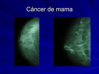 Cáncer de mama 