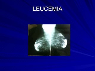 LEUCEMIA 