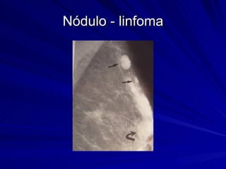 Nódulo - linfoma 