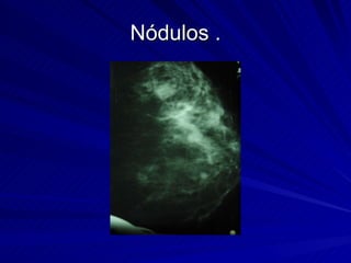 Nódulos . 