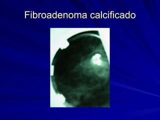 Fibroadenoma calcificado 