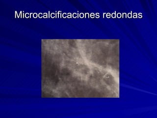 Microcalcificaciones redondas 
