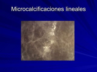 Microcalcificaciones lineales 