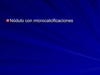 Nódulo con microcalcificaciones 