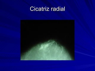 Cicatriz radial 