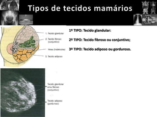 1º TIPO: Tecido glandular:

2º TIPO: Tecido fibroso ou conjuntivo;

3º TIPO: Tecido adiposo ou gorduroso.
 