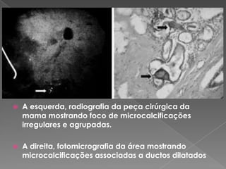  A esquerda, radiografia da peça cirúrgica da
mama mostrando foco de microcalcificações
irregulares e agrupadas.
 A direita, fotomicrografia da área mostrando
microcalcificações associadas a ductos dilatados
 