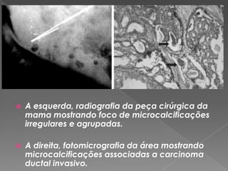  A esquerda, radiografia da peça cirúrgica da
mama mostrando foco de microcalcificações
irregulares e agrupadas.
 A direita, fotomicrografia da área mostrando
microcalcificações associadas a carcinoma
ductal invasivo.
 