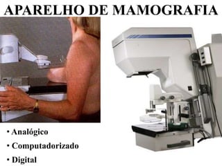 APARELHO DE MAMOGRAFIA
• Analógico
• Computadorizado
• Digital
 