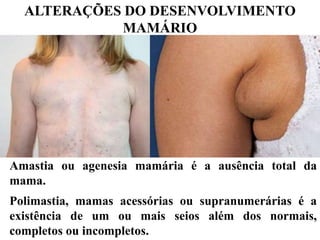 ALTERAÇÕES DO DESENVOLVIMENTO
MAMÁRIO
Amastia ou agenesia mamária é a ausência total da
mama.
Polimastia, mamas acessórias ou supranumerárias é a
existência de um ou mais seios além dos normais,
completos ou incompletos.
 