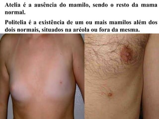 Atelia é a ausência do mamilo, sendo o resto da mama
normal.
Politelia é a existência de um ou mais mamilos além dos
dois normais, situados na aréola ou fora da mesma.
 
