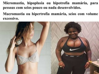 Micromastia, hipoplasia ou hipotrofia mamária, para
pessoas com seios pouco ou nada desenvolvidos.
Macromastia ou hipertrofia mamária, seios com volume
excessivo.
 