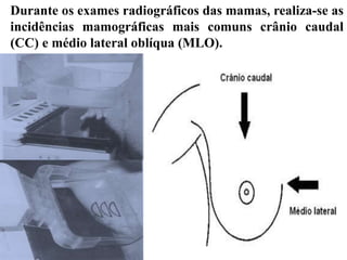 Durante os exames radiográficos das mamas, realiza-se as
incidências mamográficas mais comuns crânio caudal
(CC) e médio lateral oblíqua (MLO).
 
