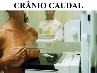 CRÂNIO CAUDAL
 