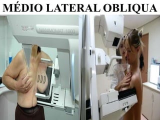 MÉDIO LATERAL OBLIQUA
 