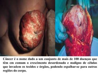 Câncer é o nome dado a um conjunto de mais de 100 doenças que
têm em comum o crescimento desordenado e maligno de células
que invadem os tecidos e órgãos, podendo espalhar-se para outras
regiões do corpo.
 