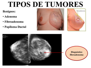 TIPOS DE TUMORES
Diagnóstico
fibroadenoma
Benignos:
• Adenoma
• Fibroadenoma
• Papiloma Ductal
 
