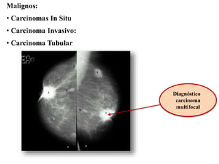 Diagnóstico
carcinoma
multifocal
Malignos:
• Carcinomas In Situ
• Carcinoma Invasivo:
• Carcinoma Tubular
 