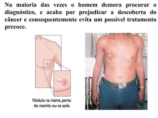 Na maioria das vezes o homem demora procurar o
diagnóstico, e acaba por prejudicar a descoberta do
câncer e consequentemente evita um possível tratamento
precoce.
 