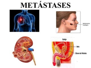 METÁSTASES
 