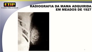 RADIOGRAFIA DA MAMA ADQUIRIDA
EM MEADOS DE 1927
9
 