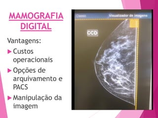 MAMOGRAFIA
DIGITAL
Vantagens:
 Custos
operacionais
 Opções de
arquivamento e
PACS
 Manipulação da
imagem
 
