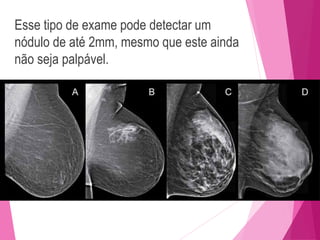 Esse tipo de exame pode detectar um
nódulo de até 2mm, mesmo que este ainda
não seja palpável.
 