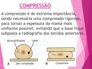 COMPRESSÃO
A compressão é de extrema importância,
sendo necessária uma compressão rigorosa,
para tornar a espessura da mama mais
uniforme possível, evitando que a base fique
subposta a radiografia dos tecidos anteriores.
 