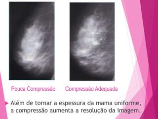Pouca Compressão Compressão Adequada
 Além de tornar a espessura da mama uniforme,
a compressão aumenta a resolução da imagem.
 