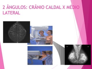 2 ÂNGULOS: CRÂNIO CALDAL X MÉDIO
LATERAL
 