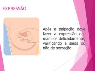 EXPRESSÃO
Após a palpação deve
fazer a expressão dos
mamilos delicadamente,
verificando a saída ou
não de secreção.
 