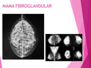 MAMA FIBROGLANDULAR
 