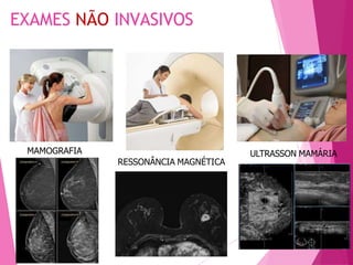 EXAMES NÃO INVASIVOS
MAMOGRAFIA
RESSONÂNCIA MAGNÉTICA
ULTRASSON MAMÁRIA
 
