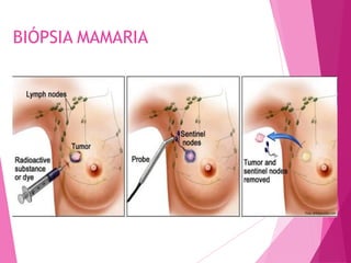 BIÓPSIA MAMARIA
 