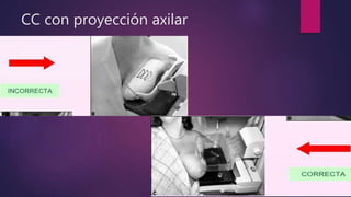 CC con proyección axilar
 
