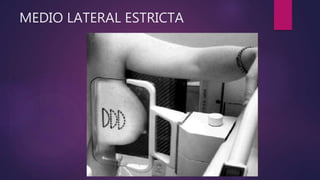 MEDIO LATERAL ESTRICTA
 