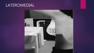 LATEROMEDIAL
 