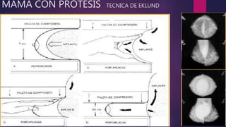 MAMA CON PROTESIS TECNICA DE EKLUND
 