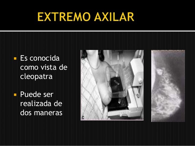 Mamografía Bilateral con Prolongación Axilar ¡Descubre la Verdad! Mamografia bilateral con prolongacion axilar